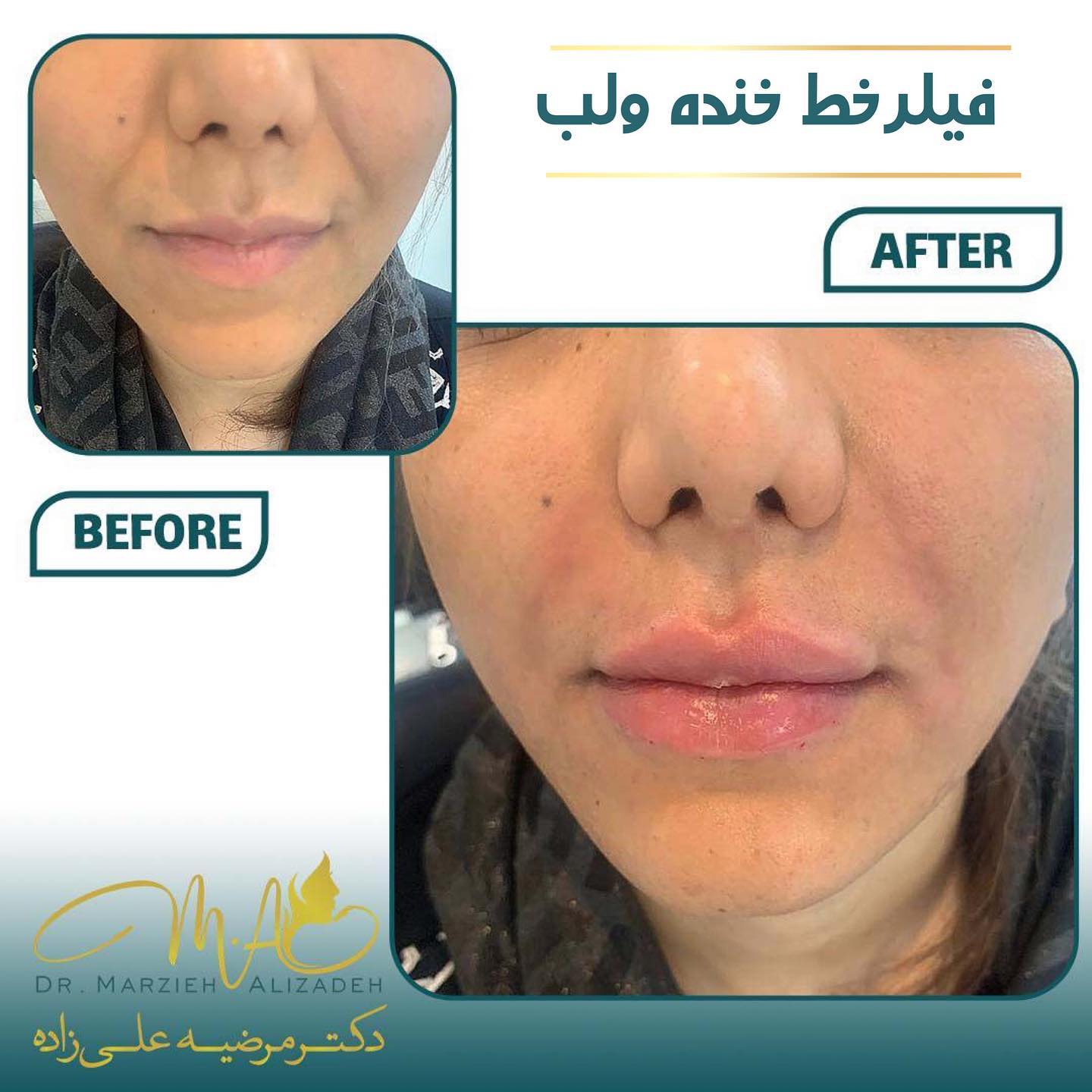 دکتر مرضیه علیزاده  لب روسی  فیلر  خط خنده  زاویه سازی صورت  زاویه فک  مادلینگ صورت  ژل لب  شهریار  اندیشه  ساکشن غبغب