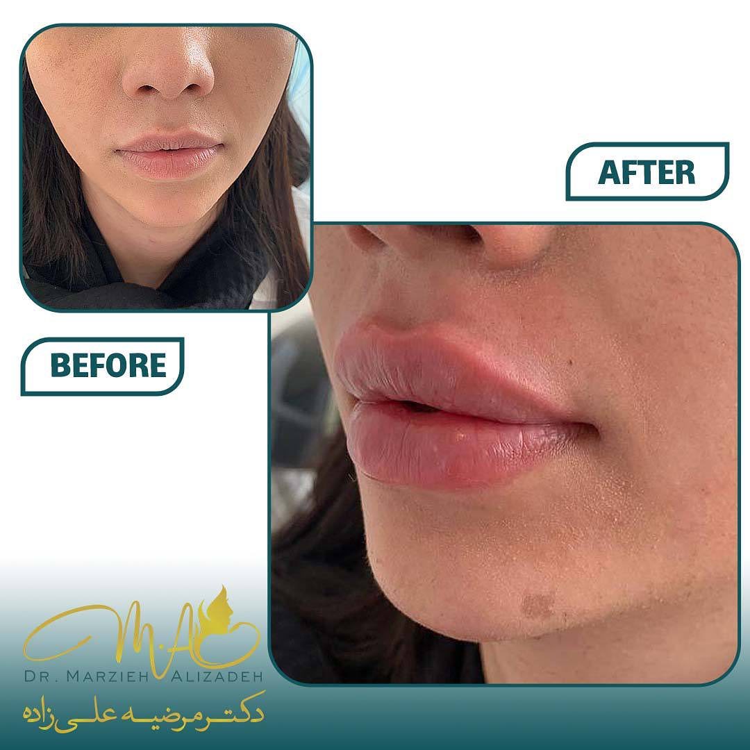 دکتر مرضیه علیزاده لب روسی  فیلر  بوتاکس  زاویه سازی صورت  زاویه فک  مادلینگ صورت  ژل لب  شهریار  اندیشه  ساکشن غبغب