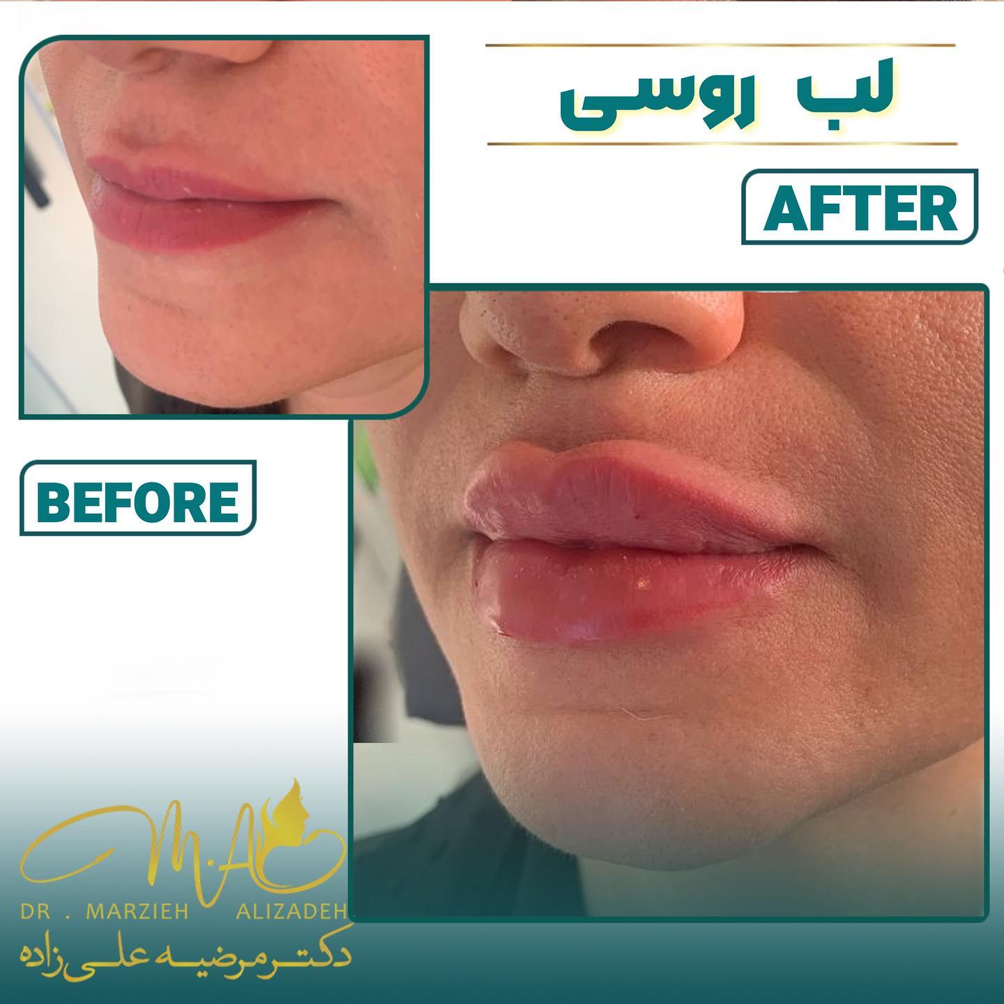 دکتر مرضیه علیزاده لیفت لب روسی نچرال فیلر ژل ژل روسی کلینیک زیبایی کرج کلینیک زیبایی اندیشه ژل طبیعی عروسکی