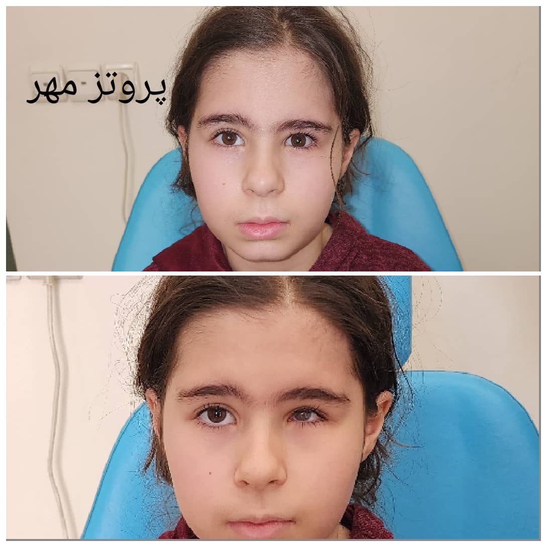 پروتز چشم مهر تهران  پروتز اسکلراشل پروتزیست  آناپلاستولوژي  چشم پزشکی  چشم مصنوعی  لنز چشم  جراحی زیبایی  پلک