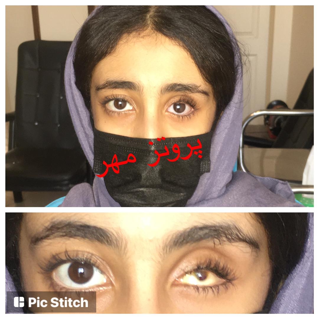 پروتز چشم مهر تهران پروتز اسکلراشل  پروتزیست  آناپلاستولوژي  چشم پزشکی  چشم مصنوعی  لنز چشم  جراحی زیبایی  پلک