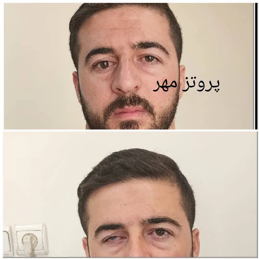 پروتز چشم مهر تهران پروتز اسکلراشل پروتزیست  آناپلاستولوژي  چشم پزشکی  چشم مصنوعی  لنزچشم  جراحی زیبایی پلک