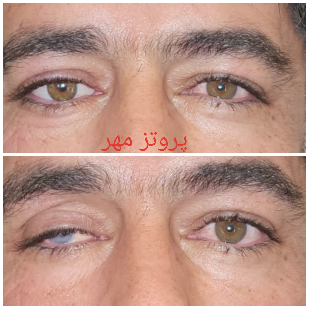پروتز چشم مهر تهران پروتز اسکلراشل پروتزیست آناپلاستولوژي چشم پزشکی چشم مصنوعی  لنز چشم  جراحی زیبایی  پلک